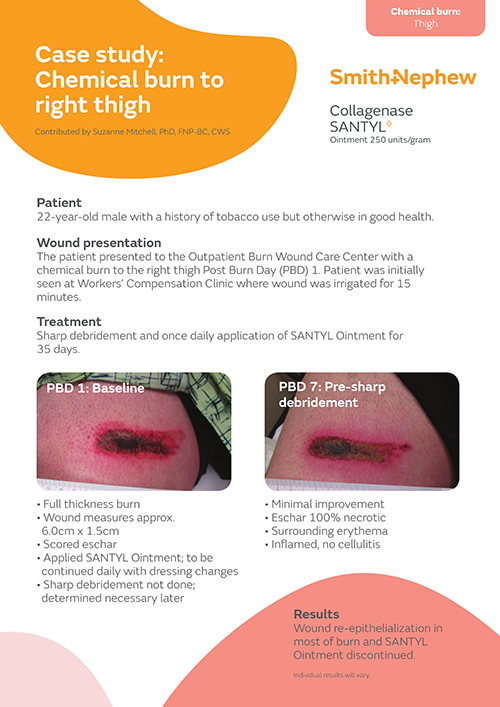 Chemical burn to right thigh