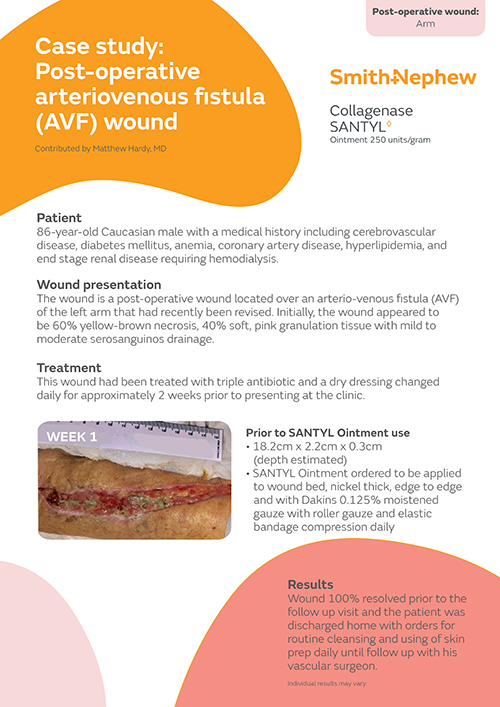 Post-operative arteriovenous fistula (AVF) wound