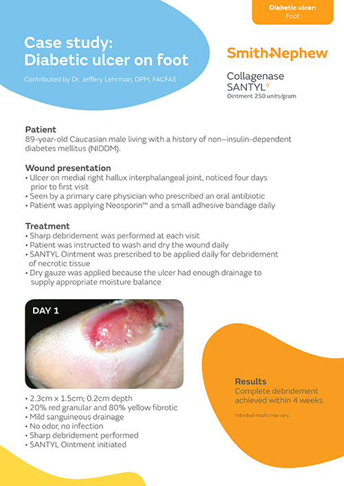 Diabetic ulcer on foot