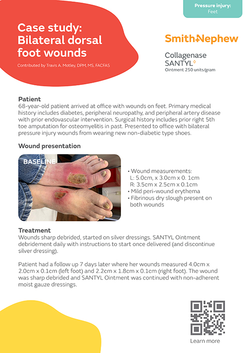 Bilateral dorsal foot wounds